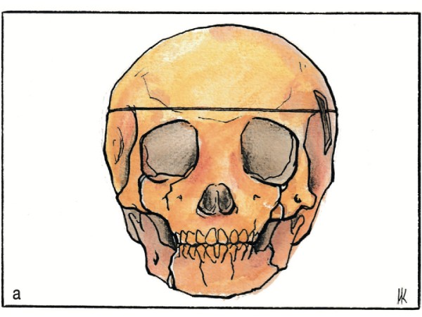 Forensische Pädopathologie: Auf der Suche nach dem Kind –zwischen Zweifel und Akzeptanz. Der Fall D. (10 Jahre, verstorben nach Verkehrsunfall)