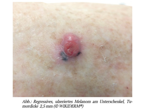 Langzeitüberleben beim Melanom (MM)