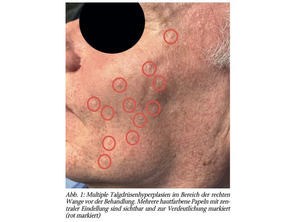 Behandlung von Talgdrüsenhyperplasien durch Nd:YAG-Laser in Kombination mit DCD-Kühlung