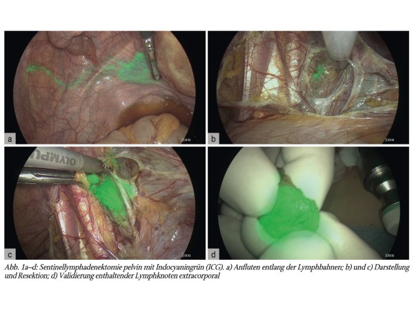 Deeskalationsstrategien bei der operativen Therapie des frühen Zervixkarzinoms