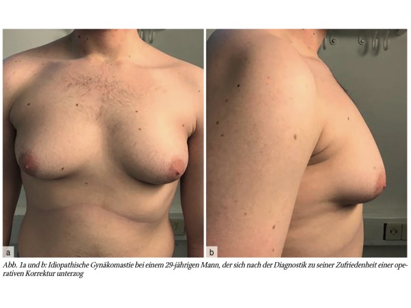 Gynäkologische Blickdiagnosen. Gynäkomastie und Lipomastie