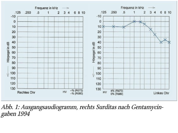 Cochleäre Migräne – eine Kasuistik