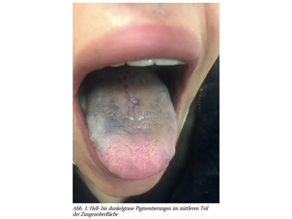 Laugier-Hunziker-Syndrom