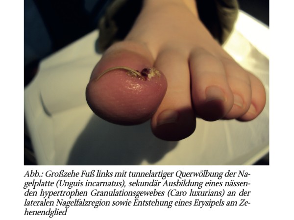 Unguis incarnatus der linken Großzehe mit Komplikationen bei einem 12-jährigen Jungen