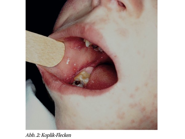 Kinderdermatologie: Aus der Praxis für die Praxis – Teil 47