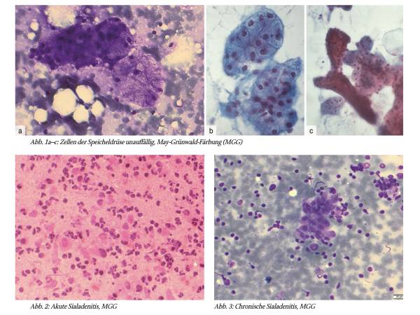Zytologie der Speicheldrüsen mit Differenzialdiagnosen