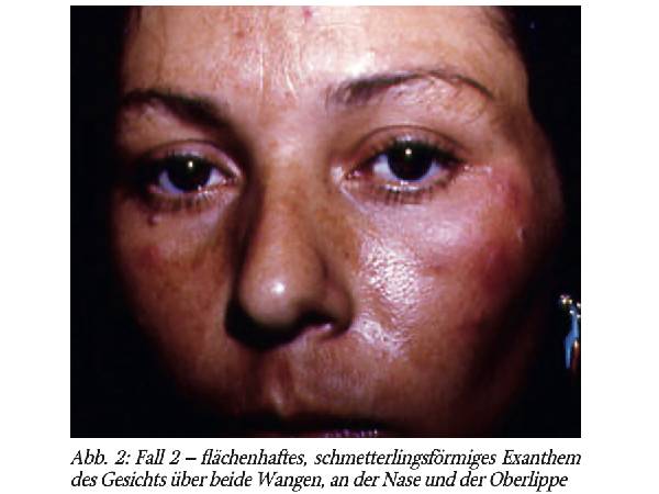 Differenzialdiagnose tropischer und kosmopolitischerErkrankungen – von Eberhard Sauerteig,bearbeitet von Dieter Reinel. Teil 30