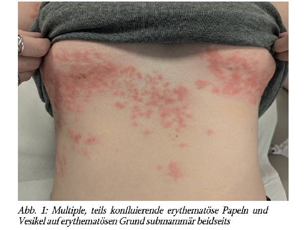 Bullöse Prurigo pigmentosa bei Erstmanifestation eines Diabetes mellitus Typ I