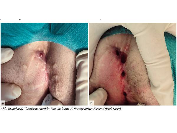 Empfehlung bei chronischem Pilonidalsinus