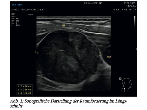 Ein ungewöhnlicher Primärtumor als vermeintliches CUP-Syndrom