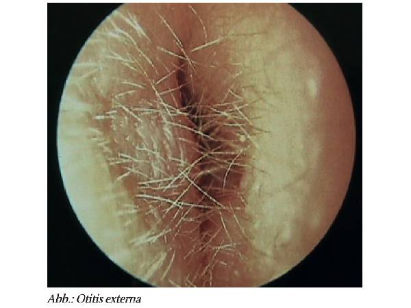 Akute Entzündungen des Ohrs: Otitis externa (OE, ICD-10 H60) – die Gehörgangsentzündung