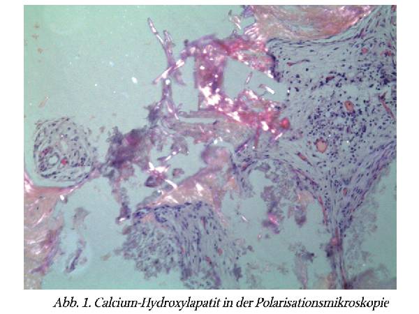Fremdkörpergranulome und verwandte Befundein der HNO-Praxis