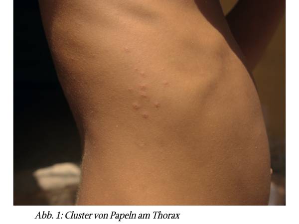 Skabies – Ektoparasitose im Aufwind