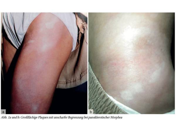 Die pansklerotische Morphea des Kindesalters – eine Übersicht