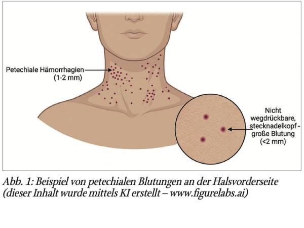 Forensische Pädo-Neuropathologie. Vom vermeintlichen Infekt zur Sinusvenenthrombose: Adenovirusbedingte Gerinnungsstörung bei einem Kleinkind