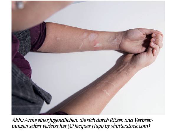 Nichtsuizidale Selbstverletzungen im Jugendalter – ein Überblickzum »Warum« und zum Umgang