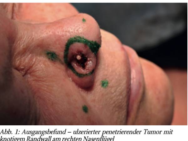 Postoperativ patientenseitig durchtrennter paramedianer Stirnlappen – ein ungewöhnlicher Fall einer autoaggressiven Handlung