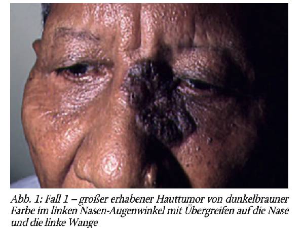 Differenzialdiagnose tropischer und kosmopolitischer Erkrankungen –von Eberhard Sauerteig, bearbeitet von Dieter Reinel. Teil 25