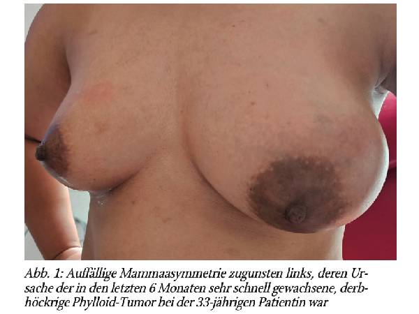 Gynäkologische Blickdiagnosen. Ein »Cystosarcoma phylloides«