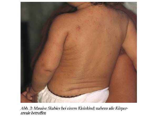 Skabies – Ektoparasitose im Aufwind