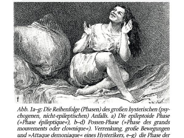 Dissoziative Anfälle in der Klinik für Neuropädiatrie. Die Rolle des Video-EEG in der Diagnose und Differenzialdiagnose