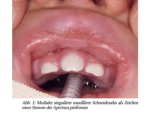 Die Naseneingangsstenose als »Notfall« beim Neugeborenen –Differenzialdiagnose und Therapie