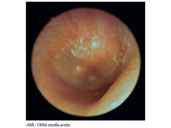 Akute Entzündungen des Ohrs: Otitis media acuta (OMA, ICD-10 H66) – die Mittelohrentzündung