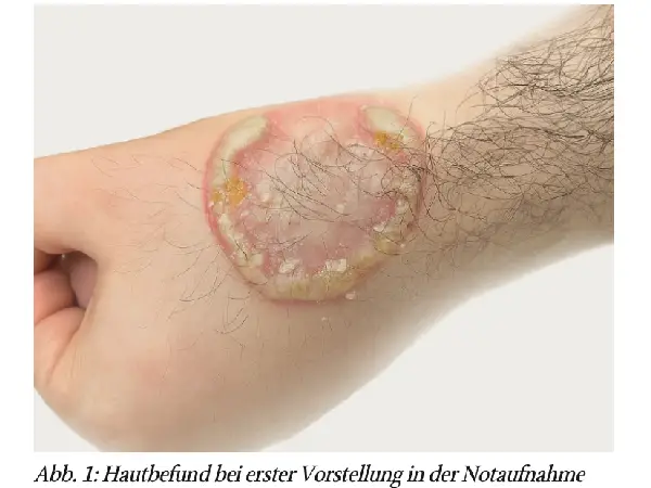 Bericht über den ersten Fall einerausgeprägten bullösen Tinea manus mit Trichophyton tonsurans und rubrum unter Immunmodulation