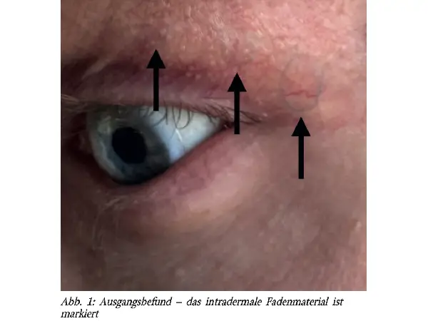 Intradermal verbliebener Prolene-Faden nach Blepharoplastik – minimal-invasive Behandlung durch gütegeschalteten Rubinlaser (694 nm)