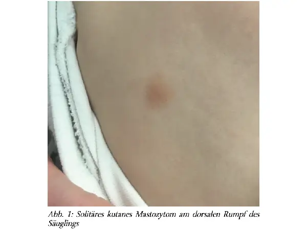 Soliäres kutanes Mastozytomim Kindesalter – Darier-Zeichen als diagnostischer Clue