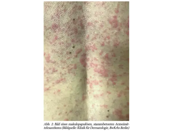 Von Haut bis Hypophyse: Immuntherapiebedingte Nebenwirkungen bei der Therapie des malignen Melanoms