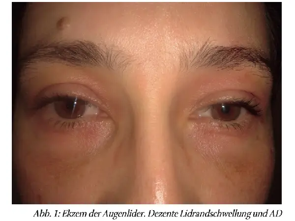 Zur Differenzialdiagnostik des atopischen Ekzems