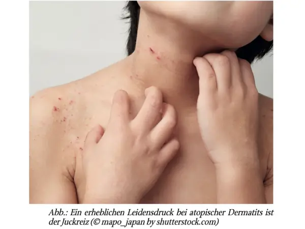 Neuartige Ansätze in der Behandlung der atopischen Dermatitis