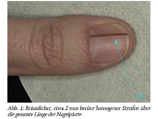 Nagelkonsile – Fragen aus der Sprechstunde. Heute: Nagelbett, Malignitätsausschluss