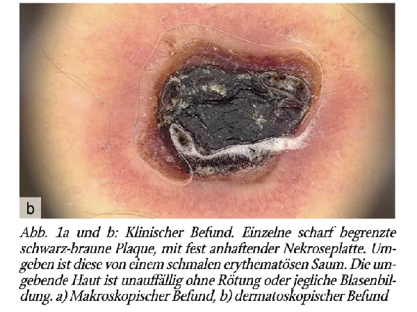 Herpetische Syringitis bei nekrotisierender Zoster-Infektion