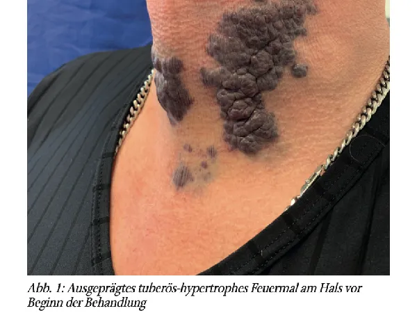 Tuberöses Feuermal am Hals – Behandlung mit dem gepulsten Nd: YAG-Laser (1.064 nm)