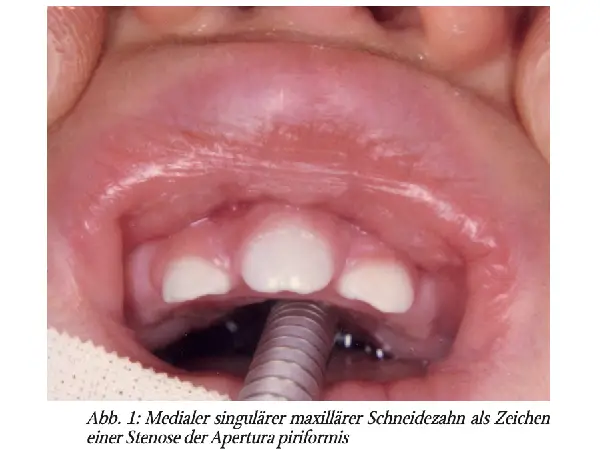 Die Naseneingangsstenose als »Notfalk« beim Neugeborenen – Differenzialdiagnose und Therapie