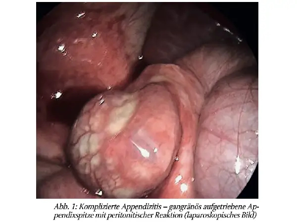 Chamäleon im Bauch: Appendizitis beim Kind. Eine narrative Bestandsaufnahme